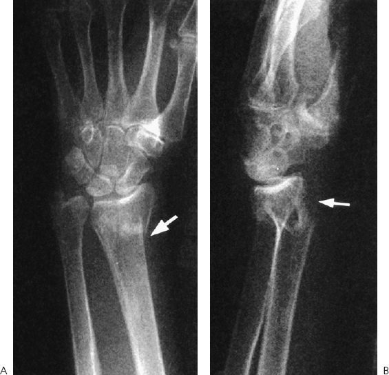 Distal Radial Fracture Splint