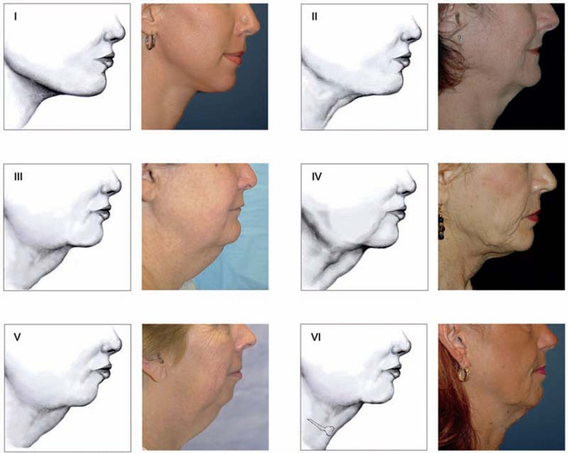 Evaluation Of The Anatomy And Aging-Related Changes Of The Neck ...