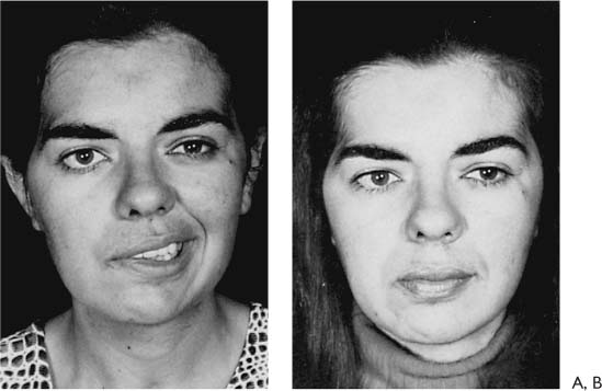 Perspective in Facial Reanimation | Plastic Surgery Key