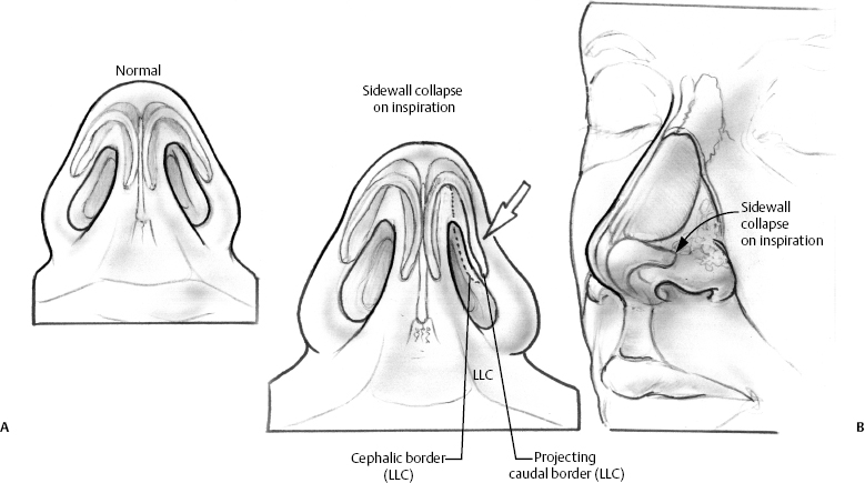 Repair Of Nasal Airway Obstruction In Revision Rhinoplasty Plastic 