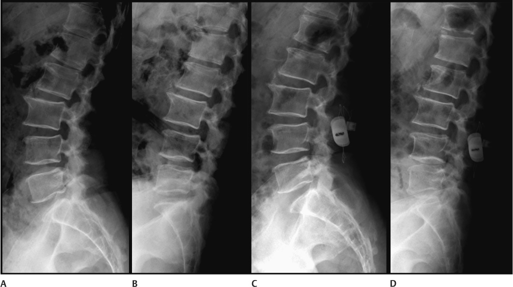 Biomechanical Considerations For Total Lumbar Disk Replacement ...