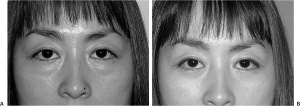 Asian Blepharoplasty | Plastic Surgery Key