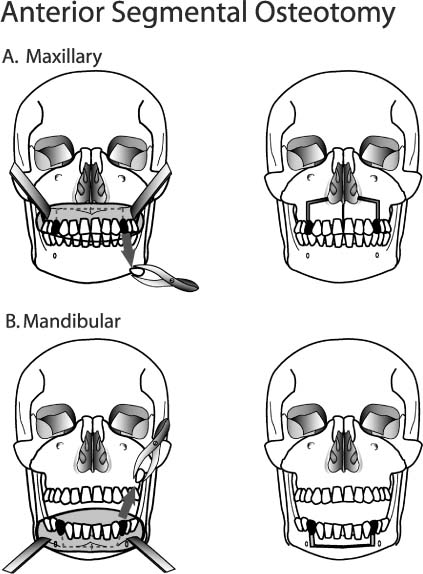 Skeletal Surgery in the Asian Face | Plastic Surgery Key