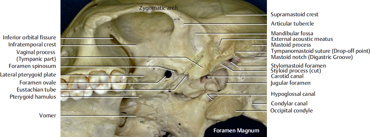 Skull: External and Internal Views | Plastic Surgery Key