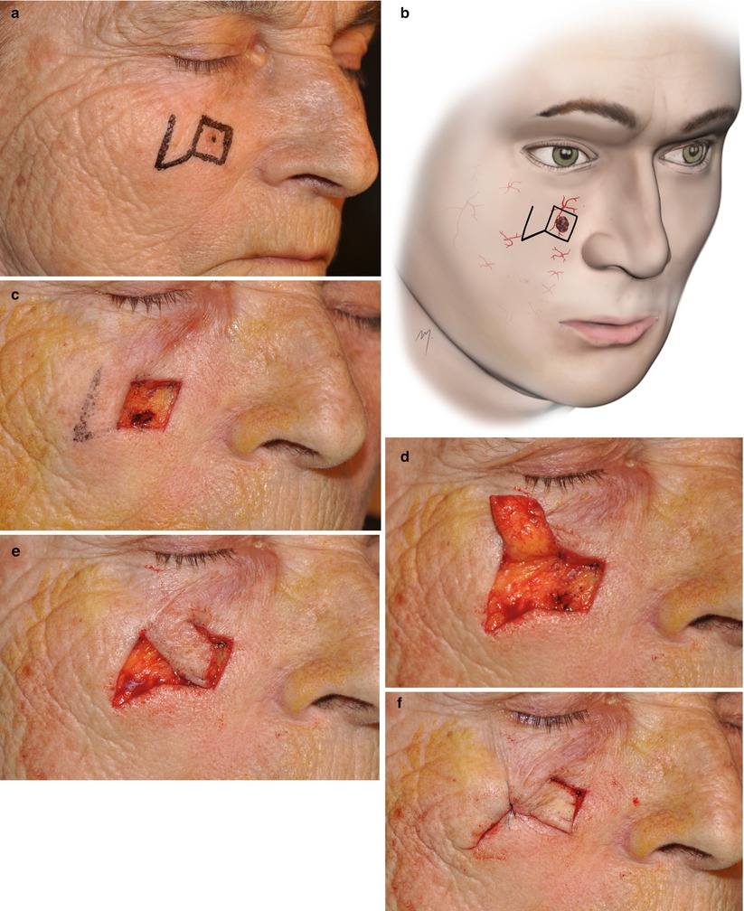 A270654_1_En_5_Fig38a_HTML.jpg