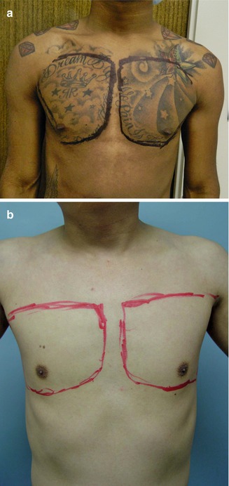 Pectoral Augmentation