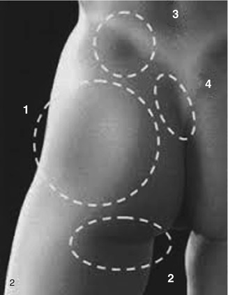 Gluteal Aesthetic Unit Classification