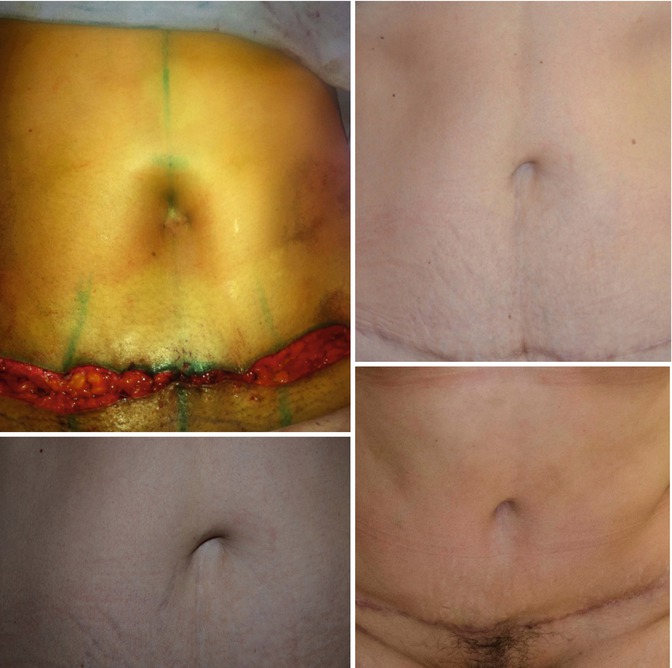 Purse-string suture technique using a mini-Pfannenstiel incision to treat  large dermoid cysts