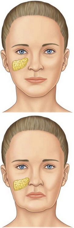 Autologous Contouring The Lower Face Plastic Surgery Key