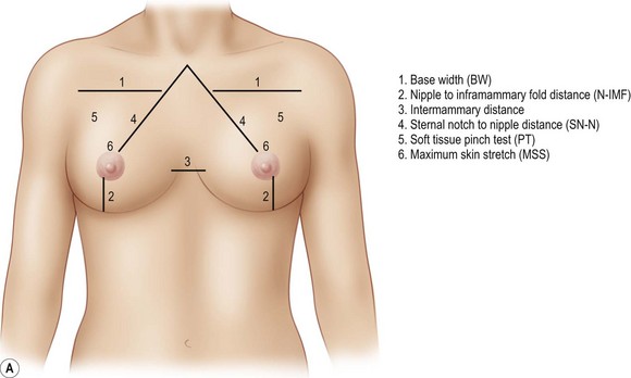 nipple position (frontal). SU: vertical distance from the sternal notch