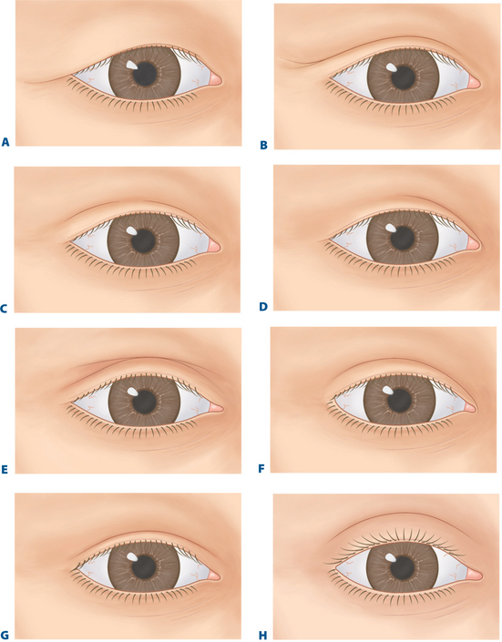 different eyelid creases