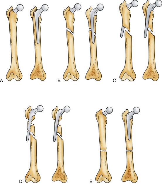 Periprosthetic Hip Fractures | Plastic Surgery Key