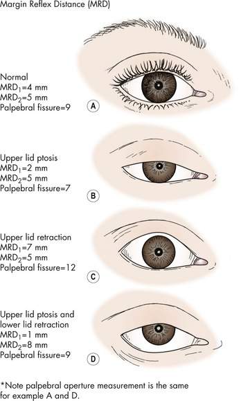 Evaluation And Treatment Of The Patient With Ptosis Plastic Surgery Key 