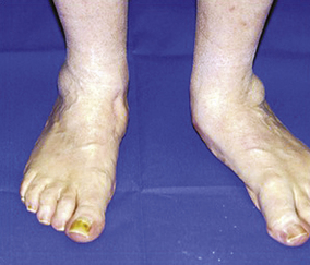 what makes va increase compensation on flat feet with deformity affecting the spine