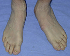 Tarsal Coalition | Plastic Surgery Key