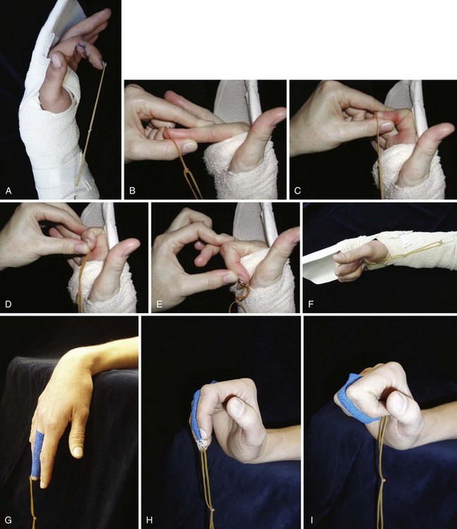 Use of crepe elastic bandage for wrist extension passive stretching
