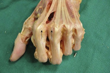 sagittal band rupture splint