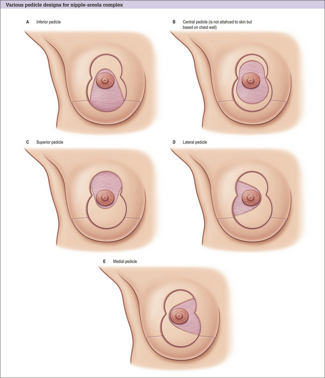 Superomedial Pedicle Vertical Breast Reduction