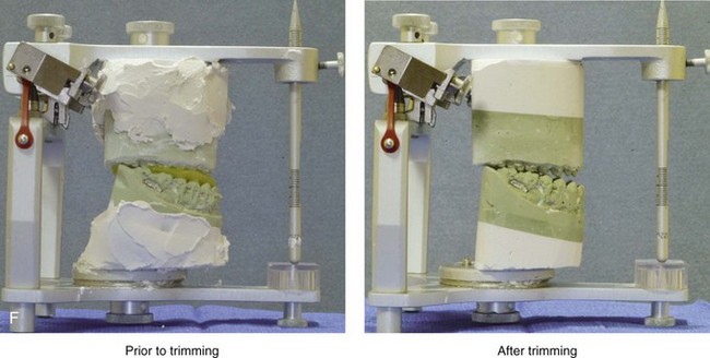 a model will maxillary trimmed be for Surgery Model Orthognathic Analytic Planning Standard