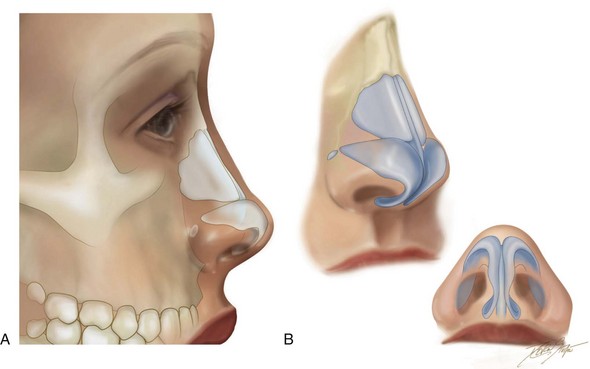 Aesthetic Alteration of the Nose: Evaluation and Surgery | Plastic