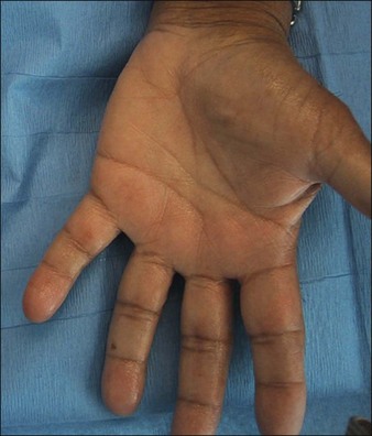 hyperhidrosis surgery