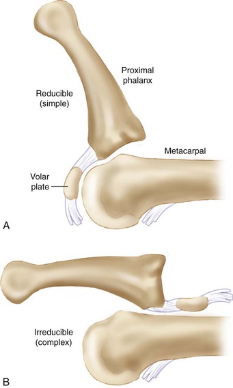 metacarpophalangeal joint dislocation