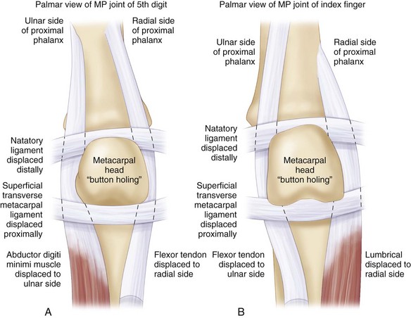 metacarpophalangeal joint dislocation