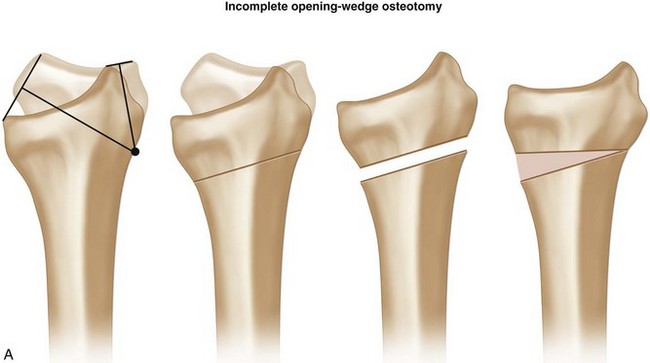 80: Corrective Osteotomy of Malunited Distal Radius Fractures | Plastic ...