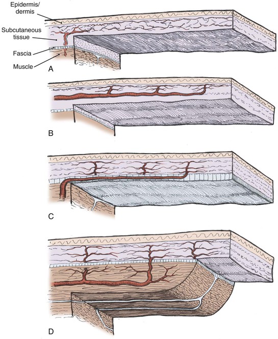 skin-flap-physiology-plastic-surgery-key