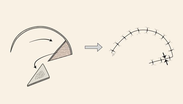 Flap Classification And Design Plastic Surgery Key