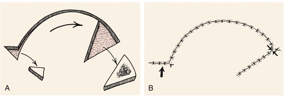 PDF] Burow's triangle advancement flap: a reliabletool on oncoplastic breast-conserving  surgery