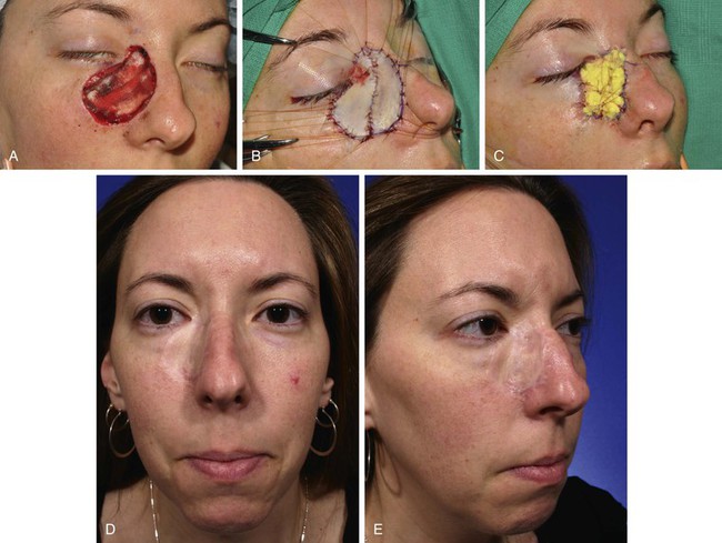 Skin And Composite Grafts Plastic Surgery Key