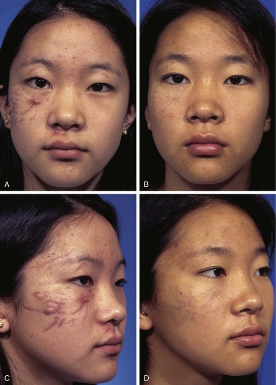 Scar Revision And Local Flap Refinement Plastic Surgery Key
