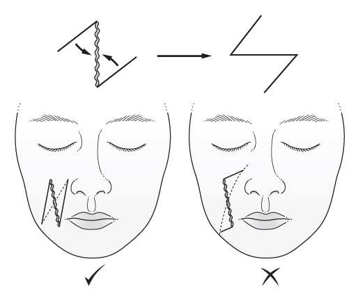 An illustration of two faces: left image, ``Z'' pattern; right image, reverse ``Z'' pattern. Same patterns appear atop the illustration; underneath are check (left) and ``X'' (right) marks.