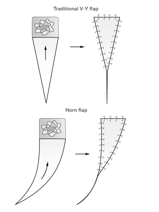 An illustration presenting 2 inverted triangular flaps; L: top, flap design to cover defect; bottom, curved V-Y advancement flap with lateral pedicle. R: top-bottom, direct closure of sites.
