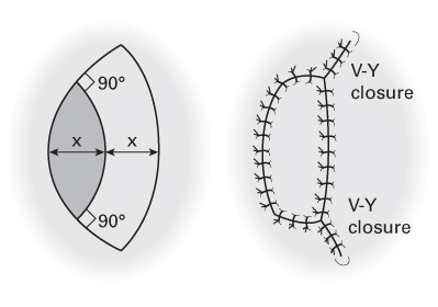Illustration presenting an elliptical defect with a curvilinear line drawn in a 90-degree angle on either end. R, closure of site with V-Y advancement at each end.