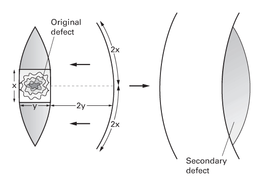 An illustration of 2 elliptical-shaped defects. L, original defect positioned parallel to a curvilinear line. R, curvilinear line parallel to the secondary defect with advancement on either side.