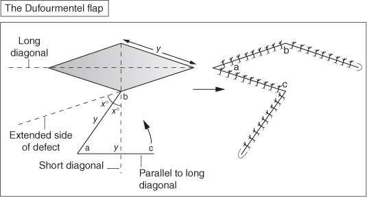 An illustration of 2 rhombus-shaped patterns. L, excised area with long and short diagonals in broken lines. Flap design is drawn from the edge of the rhombus forming an acute angle. R, closure of site.