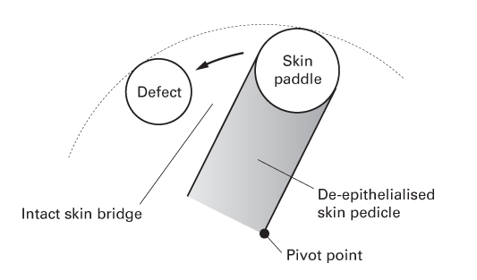 An illustration presenting two circles. The defect positioned parallel to the skin paddle at tip of a cylinder (skin pedicle). Left arrow points to the defect. Pivot point at base of skin pedicle.