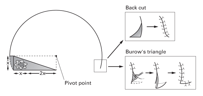 An illustration of rotational flap. Rotating along an arc to close a triangular defect. Two insets reveal back cut (closure of a triangular defect) and Burow's triangle (wedge of skin) excised and sutured (right).