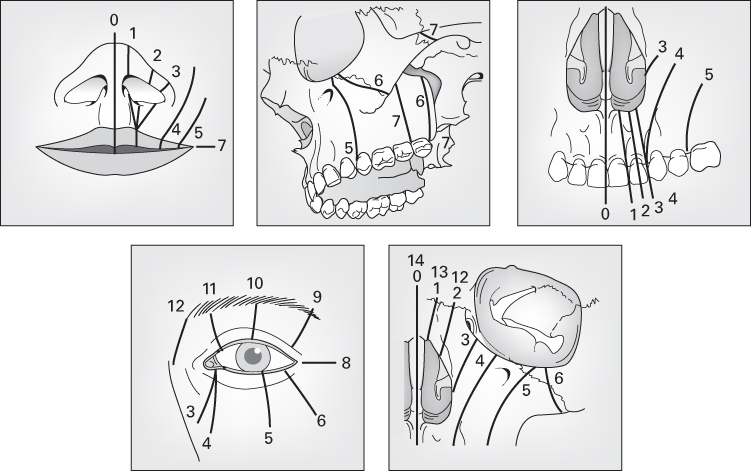 A series of diagrams of craniofacial clefts. Top: left half of face, facial bones; right half of face, soft tissue. Bottom (L-R): lip to nose, lip to orbit, orbit to cheekbone, orbit and upper lid, and medial to orbit.