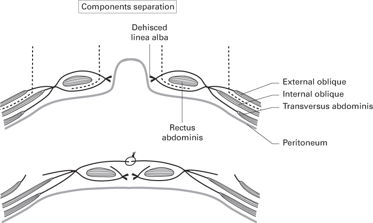 Two diagrams presenting components separation technique. Top, dehiscence of linea alba; bottom, abdominal musculature reattached to its insertion point on the linea alba.