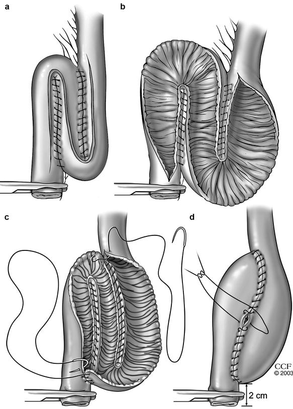 Surgical Considerations in Reoperative Pouch Anal Anastomosis Plastic