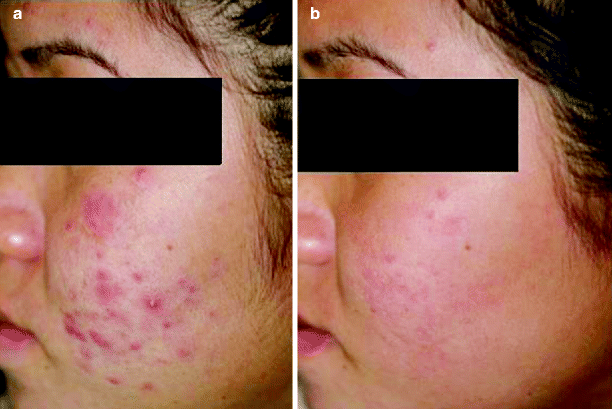 and Light Therapies for Acne | Plastic Surgery Key