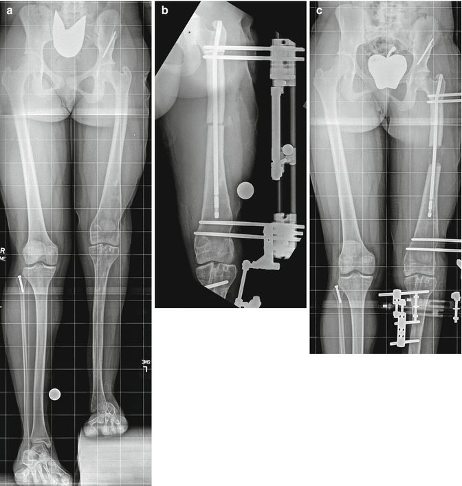 Tibia Lengthening and Deformity Correction With a Multiplanar External  Fixator