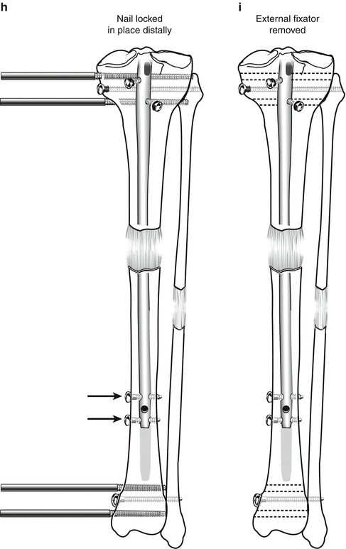 Lengthening Over Nails (LON): Femur And Tibia | Plastic Surgery Key