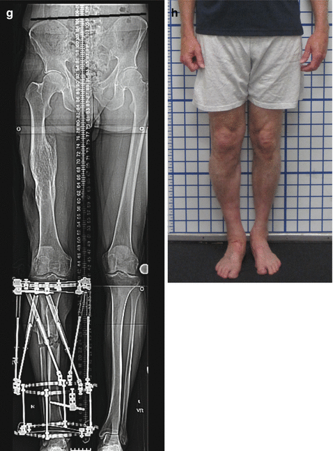 Medicina | Free Full-Text | Helical Plating Compared with Straight Plating  and Nailing for Treatment of Proximal Third Humeral Shaft Fractures—A  Biomechanical Study