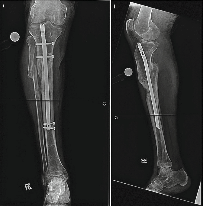 Masterclass on Essential concepts of bone plating and intramedullary nailing  - YouTube