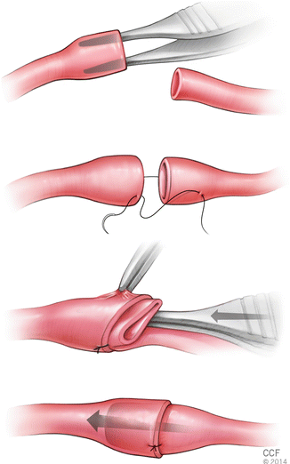 The Meaning Of Surgical Anastomosis
