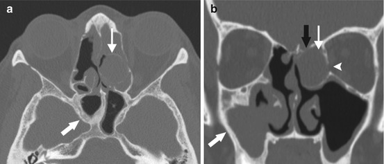 Radiographic Diagnosis Of Chronic Rhinosinusitis Plastic Surgery Key